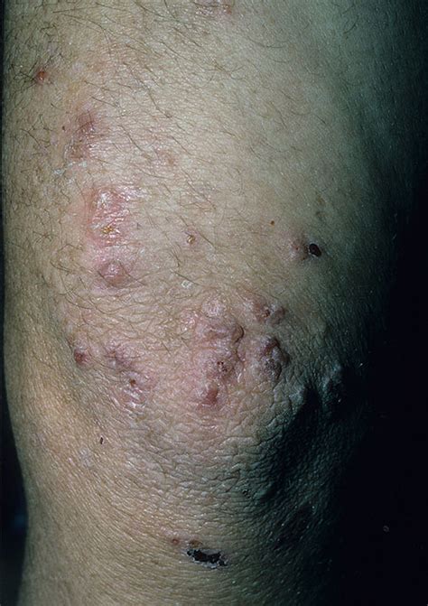 Dermatitis Herpetiformis Duhrings Disease التهاب الجلد العقبولي