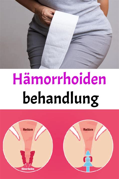 hämorrhoiden behandlung behandlung verdauungssystem nervensystem