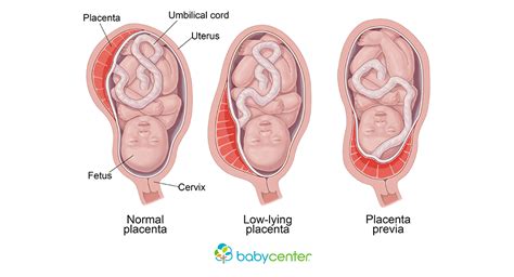 Placenta Previa Symptoms Complications And Treatment BabyCenter