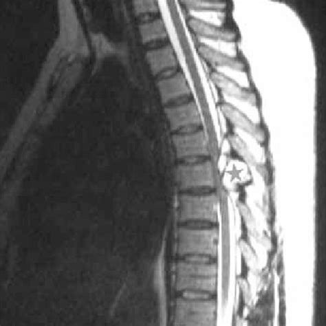 Pre Operative Sagittal T2 Weighted Mr Image Shows The Tumor As