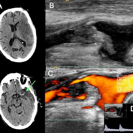 Case Carotid Ultrasonography B Mode Imaging A Of The Internal