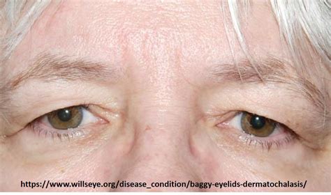 Droopy Eyelids Weber Vision Care