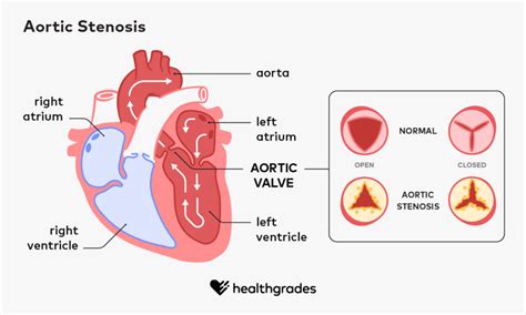 Aortic Stenosis Progression Outlook Symptoms And Treatments