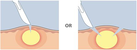 Incision And Drainage