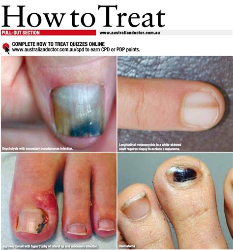 Ten Important Nail Disorders Sinclair Dermatology