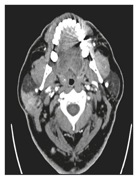 Axial Ct With Contrast Shows A Mass In The Superficial Lobe Of The