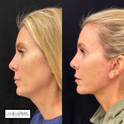 Dr Lara Devgan Md Mph Facs On Instagram “before And 1 Week After