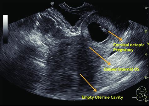 Early Cervical Ectopic Pregnancy With Embryonic Pole Transvaginal Hot