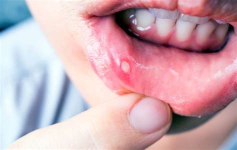 Canker Sores Causes Symptoms And Treatments Platinum Dental Surgery