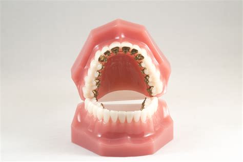 Lingual Braces In New City Ny Rockland Orthodontics