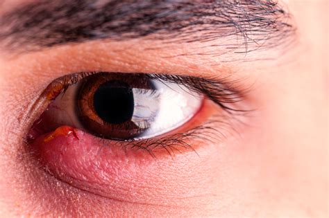 When Your Eyelids Are Inflamed — Blepharitis London England