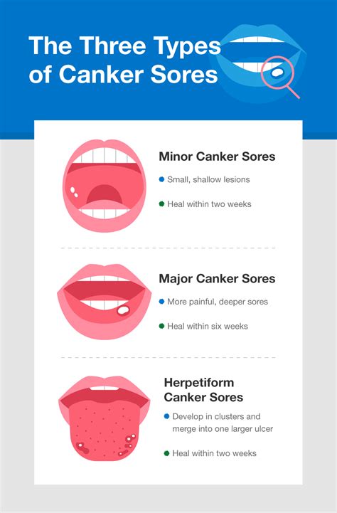 What Causes Canker Sores Sight Utility