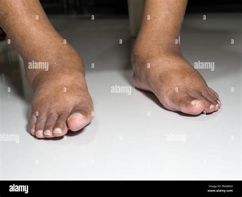The Feet Of People With Diabetes Dull And Swollen Due To The Toxicity