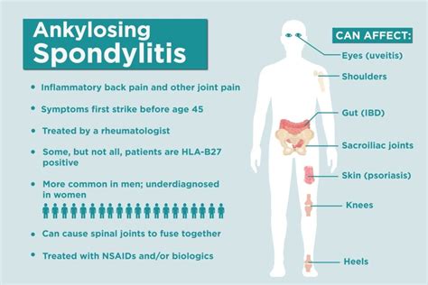 Ankylosing Spondylitis Facts 17 Things To Know About As