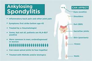 Ankylosing Spondylitis Facts 17 Things To Know About As
