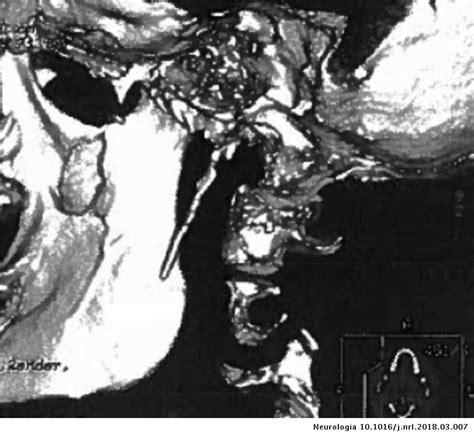 Síndrome De Eagle Hacia La Delimitación Clínica Neurología