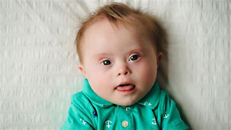 Down syndrome (us, canada and other countries) or down's syndrome (uk and other countries) encompasses a number of chromosomal abnormalities, causing highly variable degrees of learning difficulties as well as physical disabilities. Four in five children with Down syndrome are born to ...
