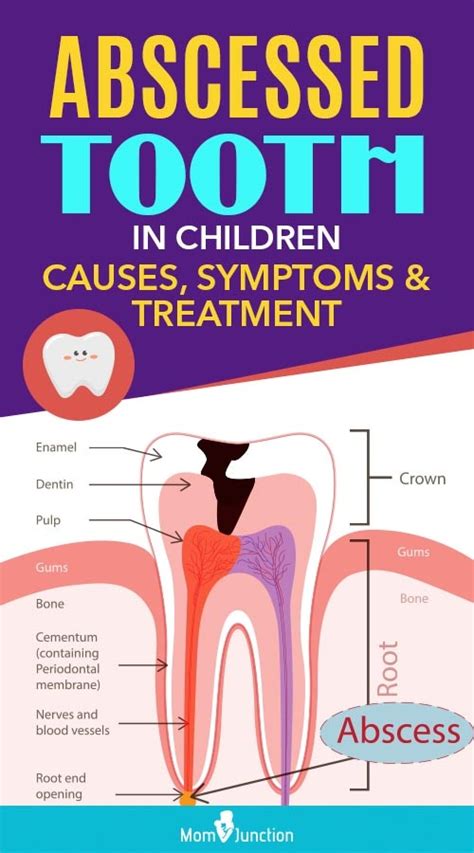 Dental Abscess Symptoms Causes Treatment Pictures