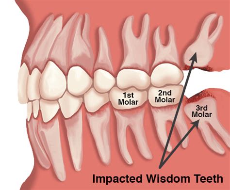Impacted Wisdom Teeth Vs Non Impacted