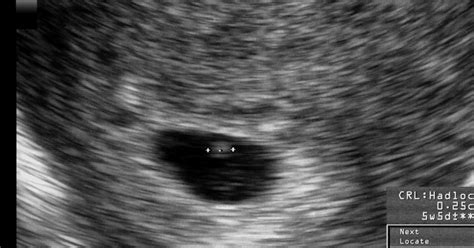 5 Weeks Ultrasound Scan All Your Questions Answered Mybump2baby