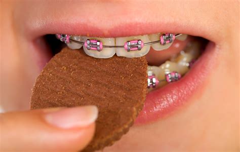 The Eating Dos And Donts Of Braces Ghosh Orthodontics