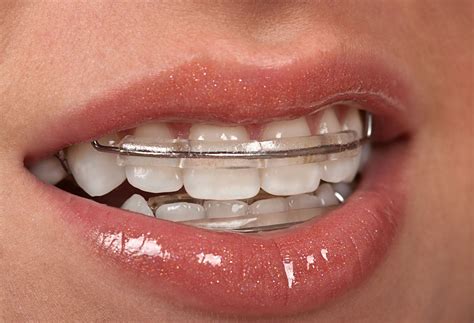 pin by ortodoncia baires on ortodoncia cosmetic braces dental braces teeth braces