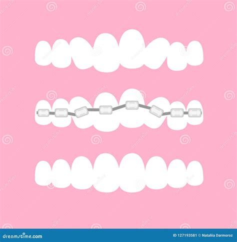 Stages Of Orthodontic Treatment Braces On Teeth Alignment Of Bite Of Teeth Dental Row With
