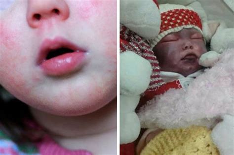 Scarlet Fever Outbreak Health Bosses Warn Parents Rashes On Kids Could