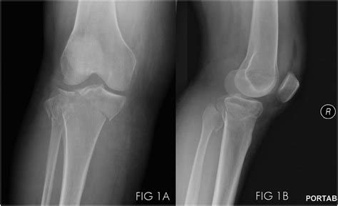 Ap Injury Film Showing Aoota41c1 Proximal Tibia Fracture 1a