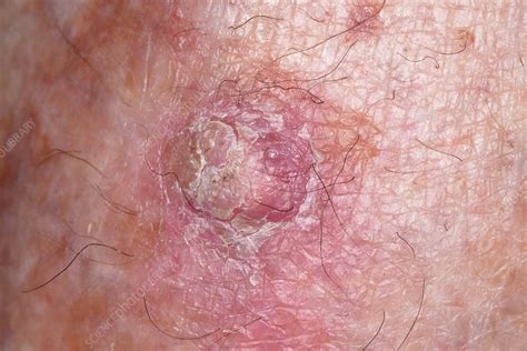 Squamous Cell Carcinoma Skin Cancer Stock Image C0294924 Science