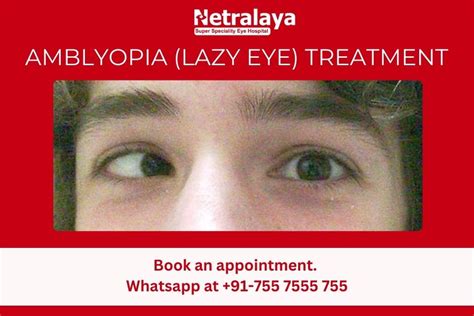 Amblyopia Lazy Eye Treatment At The Best Eye Hospital In Ahmedabad