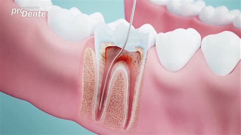 Eine wurzelbehandlung ist eine zahnmedizinische behandlungsmethode, die zur erhaltung eines zahnes mit entzündetem zahnnerv dient. Wurzelbehandlung von A-Z