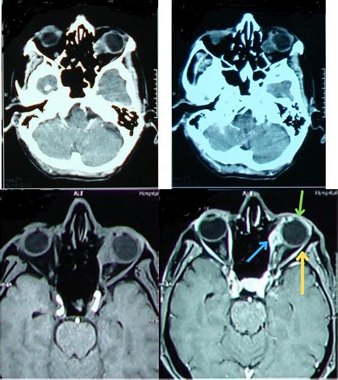 Ct Scan And Mri Of Patient Revealing Left Intraconal Mass Before And