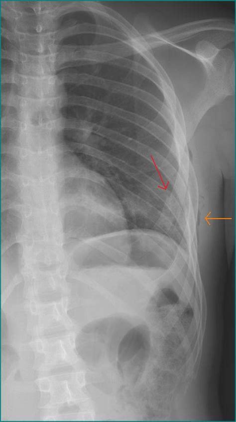 29 Yo Male Has Left Sided Chest Pain Which Started After Falling Off A