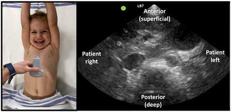 Understanding Ultrasound Images Kidsono