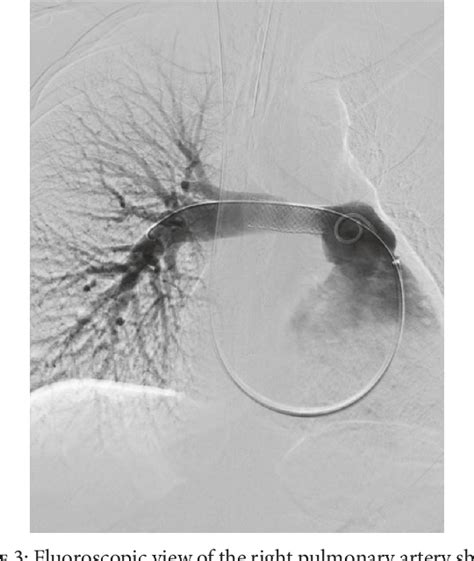 Figure 3 From Extranodal Rosaidorfman Disease Presenting As A