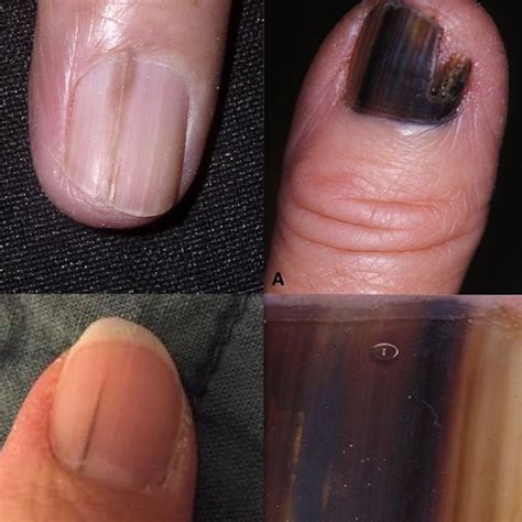 Is The Black Line On Your Nail Normal Or Melanoma How To Tell