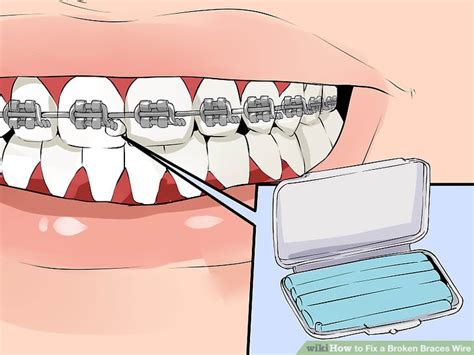 How To Fix A Broken Braces Wire 6 Steps With Pictures Wikihow