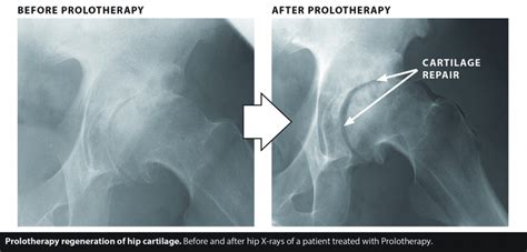 Hip Instability At The Core Of Hip Pain Conditions Southwest Florida