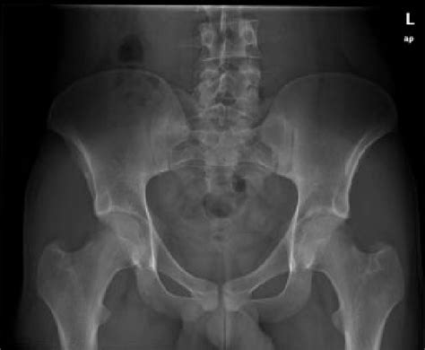 Radiograph In The Anteroposterior View Of The Pelvis Of A 27year Old