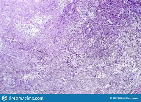 Leiomyoma Or Fibroids Is A Benign Smooth Muscle Tumor Stock Image