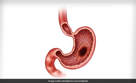 Also called gastric cancer, the disease usually grows slowly over many years. Stomach Cancer: 5 Things You Need To Know