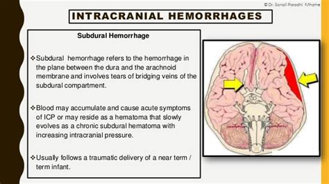 Neonatal Intracranial Hemorrhage By Dr Sonali Mhatre