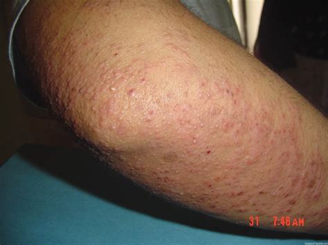 Cases Of Severe Keratosis Pilaris Keratosis Pilaris Treatment Options