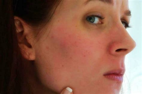 How To Get Rid Of Facial Redness