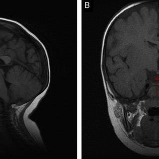 T Weighted Brain MRI Sagittal A And Coronal B Slices Moderate Download Scientific