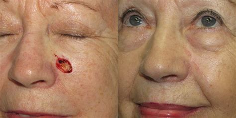 Cheek Reconstruction Gallery Skin Cancer And Reconstructive Surgery