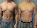 Bodybuilder Gynecomastia - Before and After Photos ⋆ Gynecomastia USA