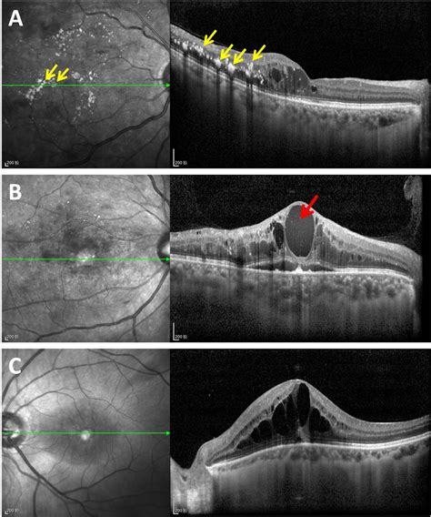 Representative SD OCT Images Of Macular Edema Secondary To Different Download Scientific