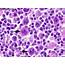 Histopathology Images Of T Cell/histiocyte Rich B Cell Lymphoma By 